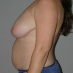 Mommy Makeover - Before Breast Reduction and Lift, Liposuction of the abdomen, Flanks, and Thighs